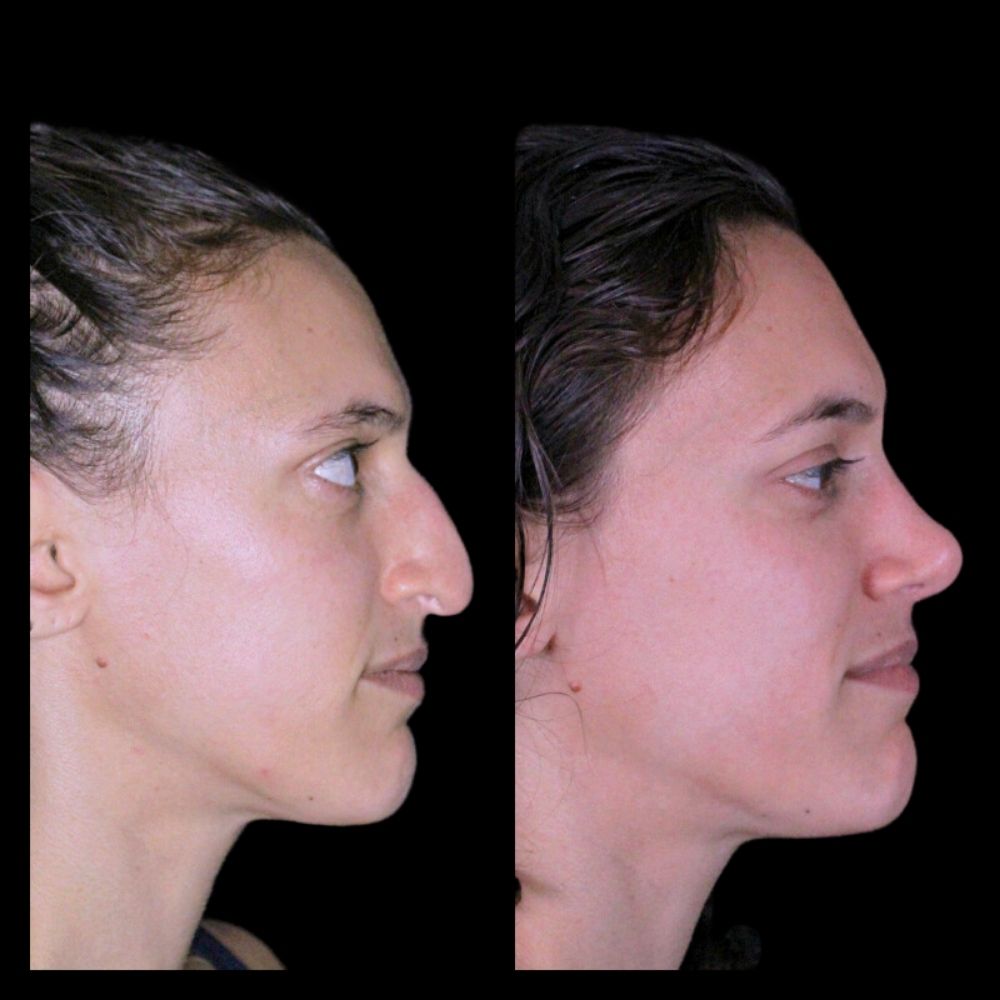 Before After Gallery - Nose 8