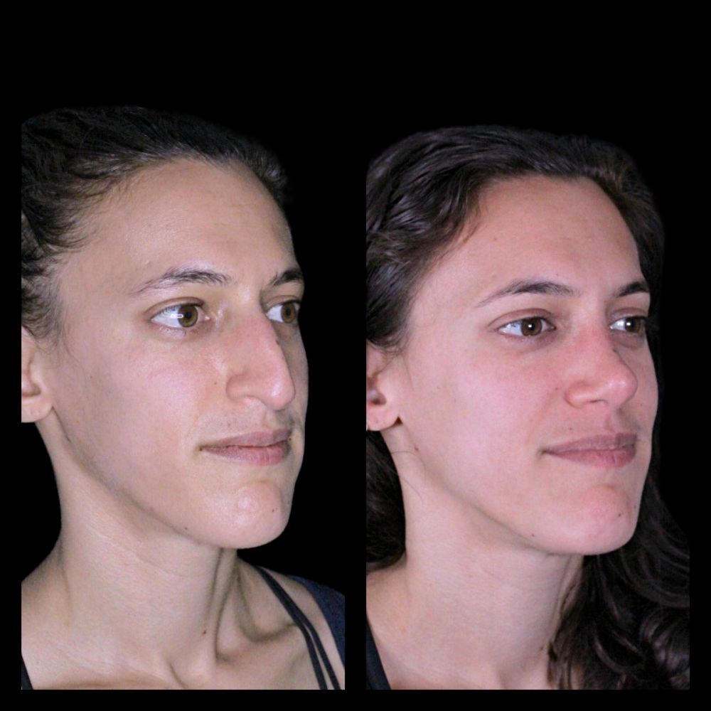 Before After Gallery - Nose 8