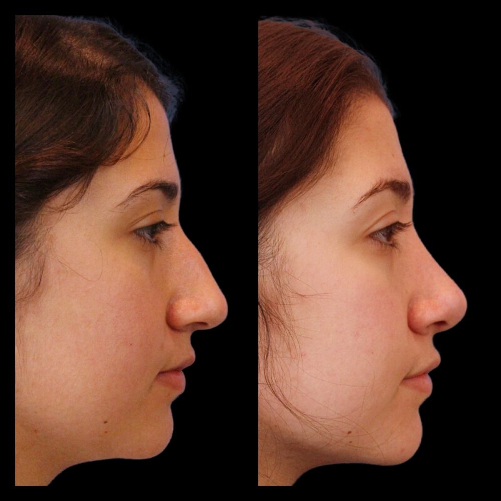 Before After Gallery - Nose 19