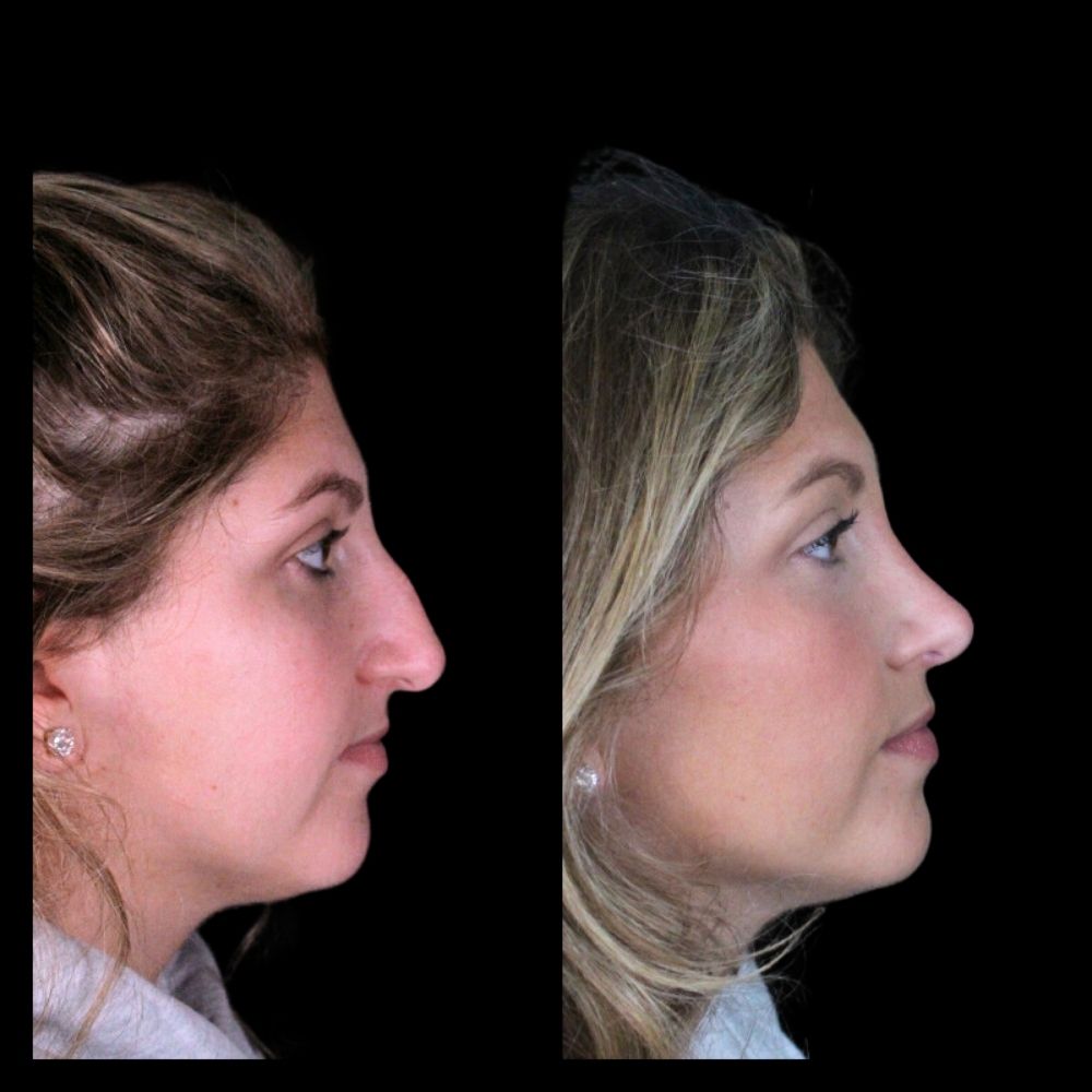 Before After Gallery - Nose 6