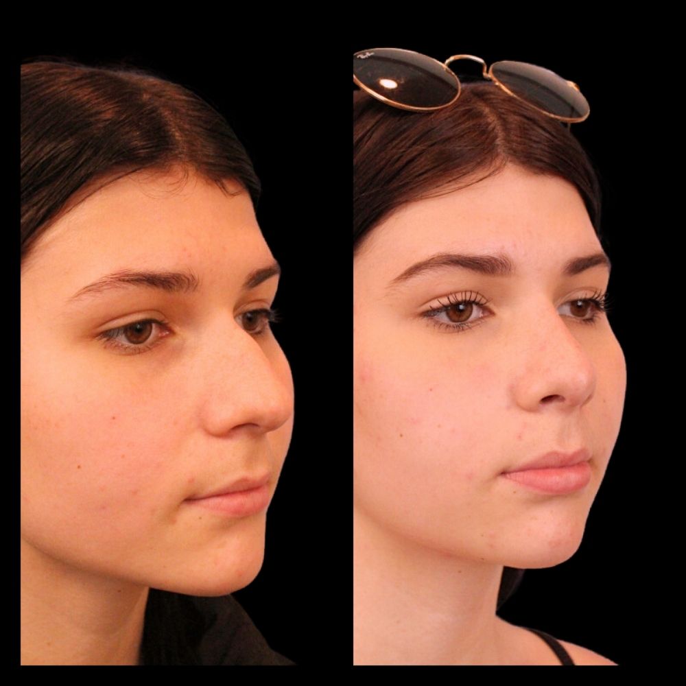 Before After Gallery - Nose 18