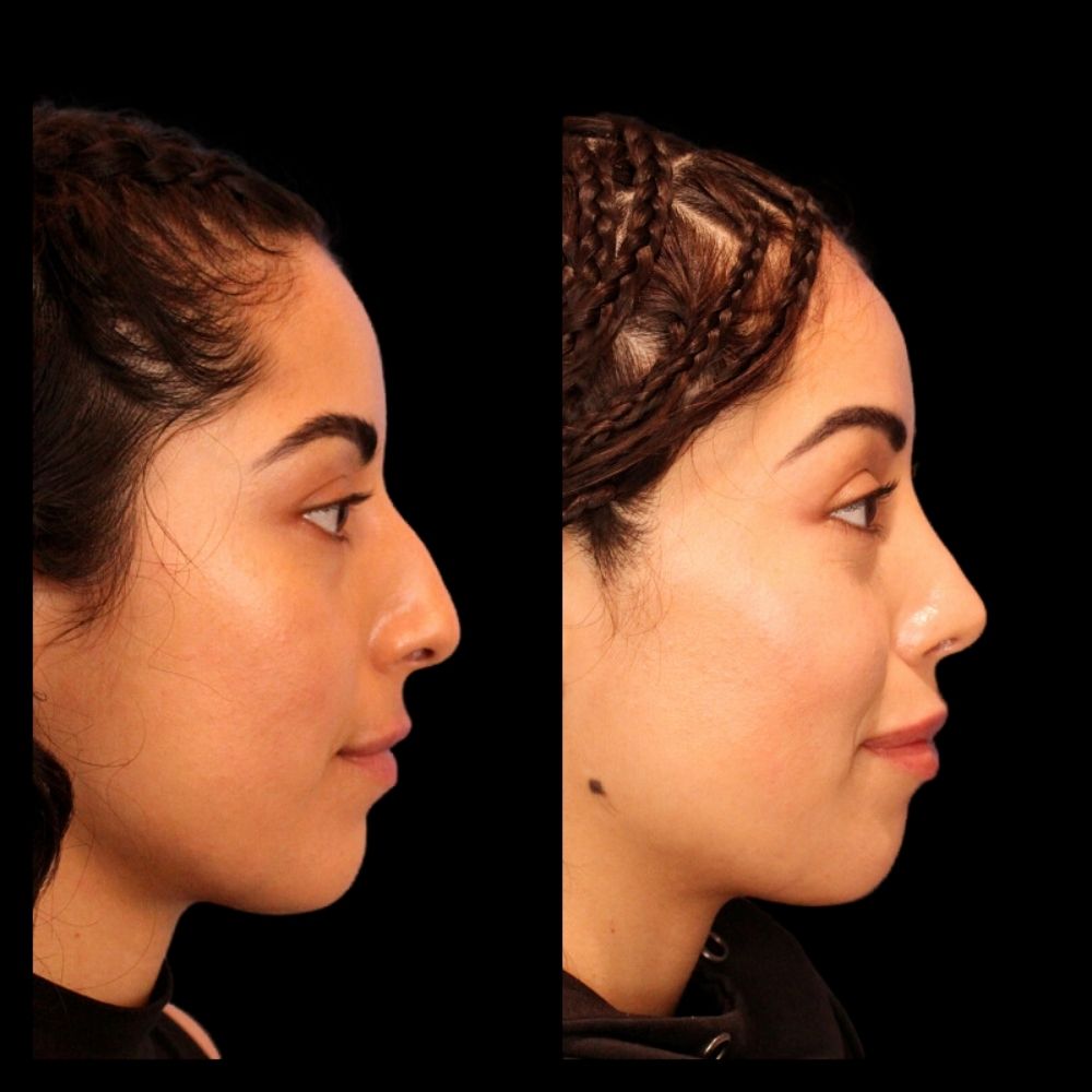 Before After Gallery - Nose 2