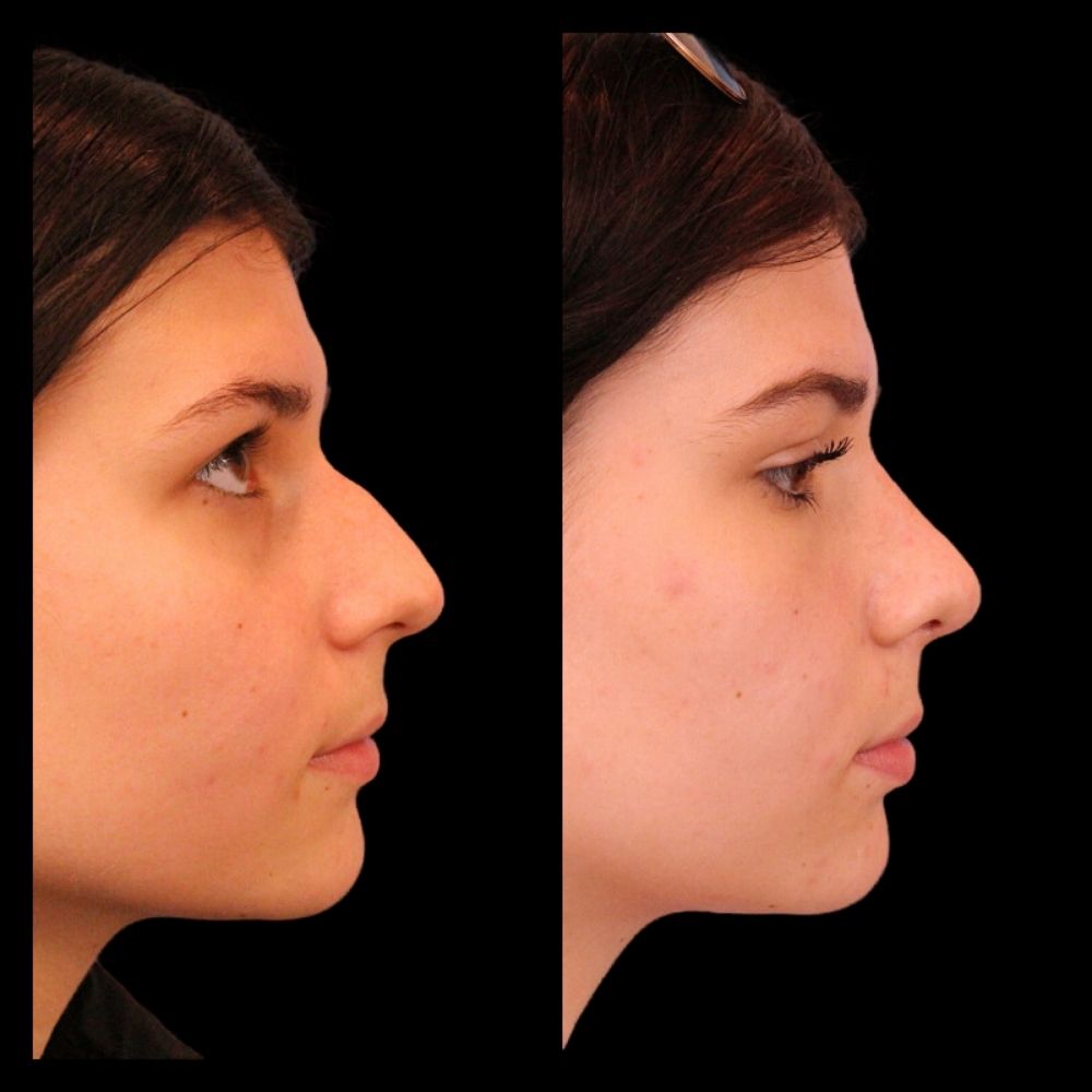 Before After Gallery - Nose 18