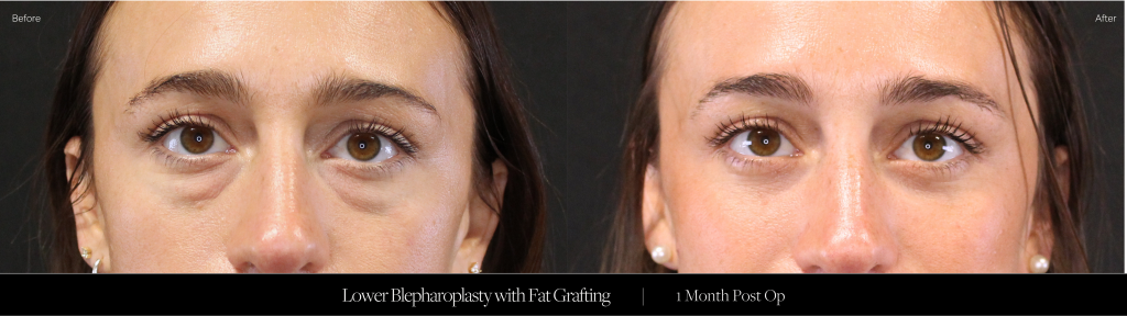 Patient who is one month post operative from a lower blepharoplasty with fat grafting